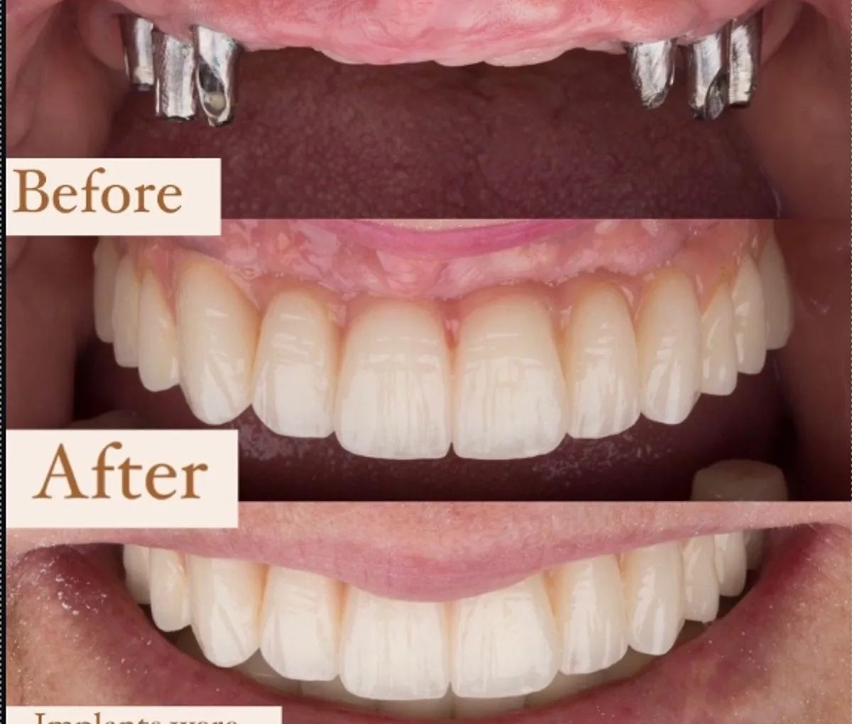Panoramic X-ray of All-on-6 implant treatment