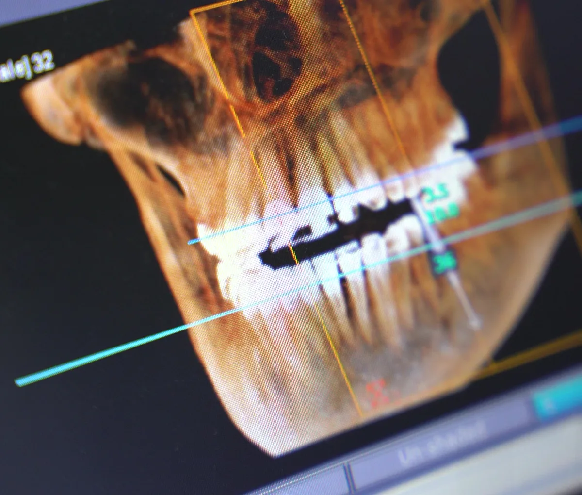 CBCT three-dimensional implant planning screen