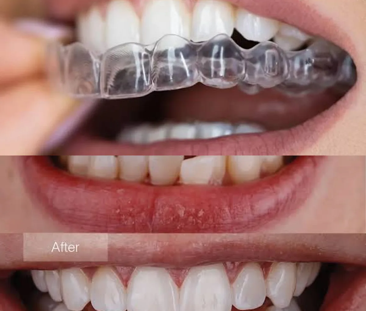 Invisalign clear aligner with before-and-after result