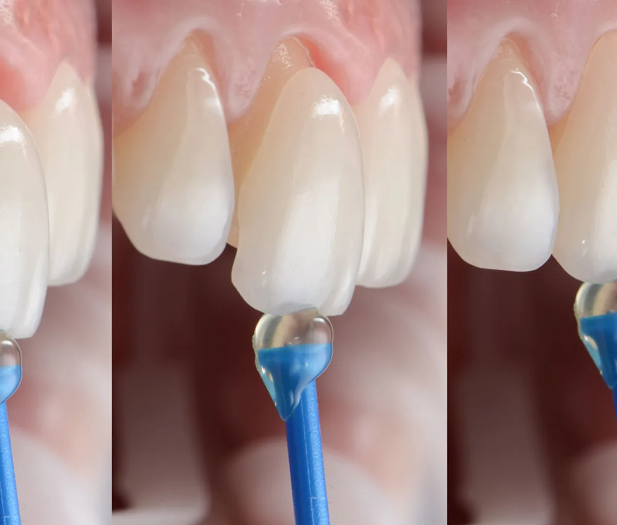 Laminate veneer treatment