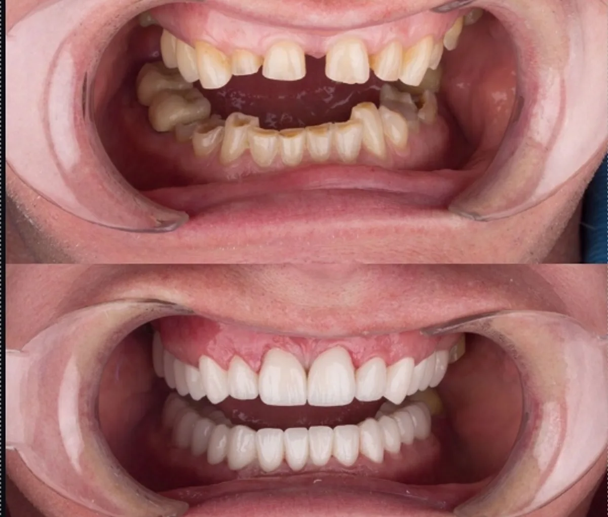 Aesthetic dental treatment procedure