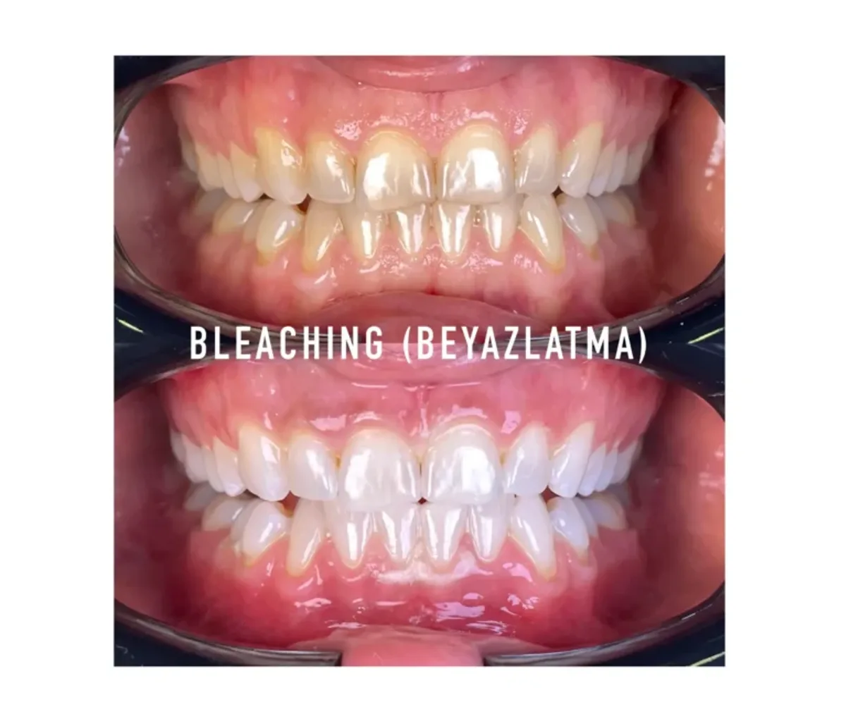 Shade guide comparison before teeth whitening