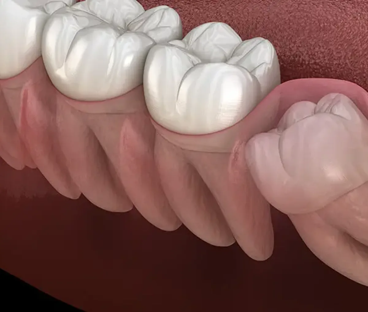 Impacted wisdom tooth surgery